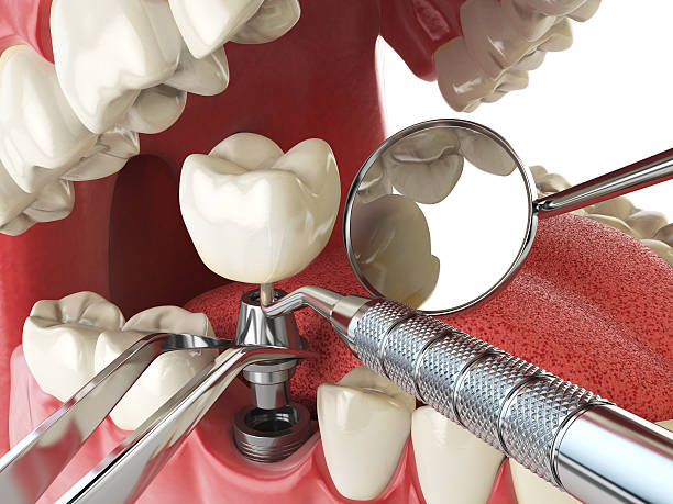 Best Emergency Wisdom Tooth Extraction in Chalfont, PA
